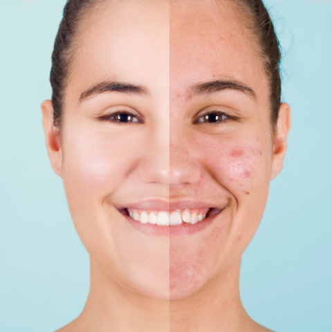 Carboxy Therapy and Facial Treatment Injections in London | Levitas