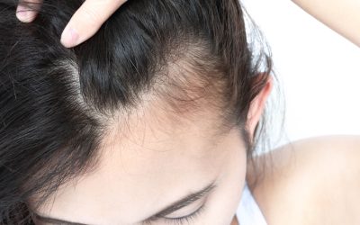 Hair Regeneration in London and Surrey: Mesotherapy for Thinning Hair and Hair Loss