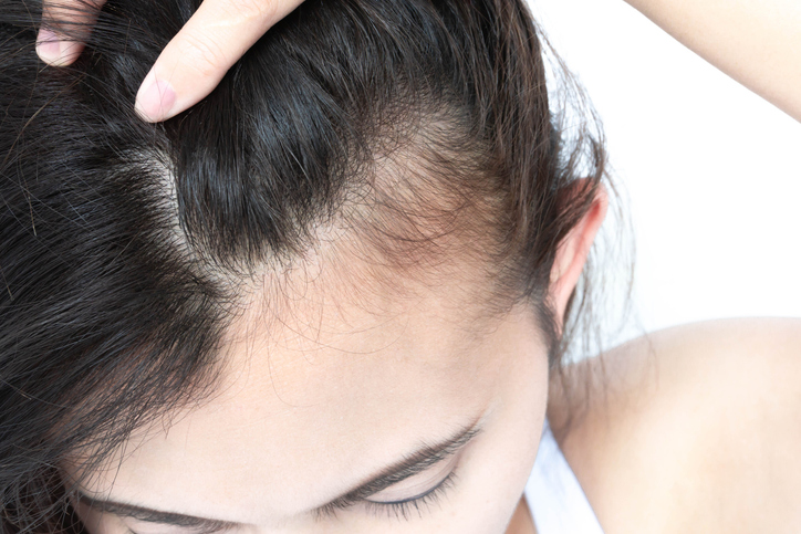 Hair Regeneration in London and Surrey: Mesotherapy for Thinning Hair and Hair Loss